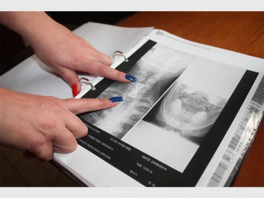OPERATION: Natalie Gunther indicates on an X-ray the steel plate that was surgically inserted into her neck.