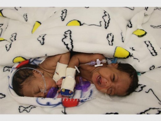 WELCOME TO THE WORLD: The two gorgeous little girls, Uwenzile and Uyihlelile Shilongonyane, being prepared for separation surgery at Netcare Unitas Hospital in Centurion.
